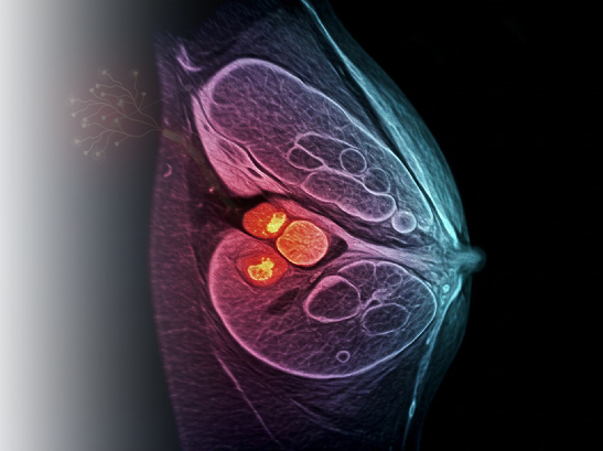 Side view image of breast cancer. (From AI)r