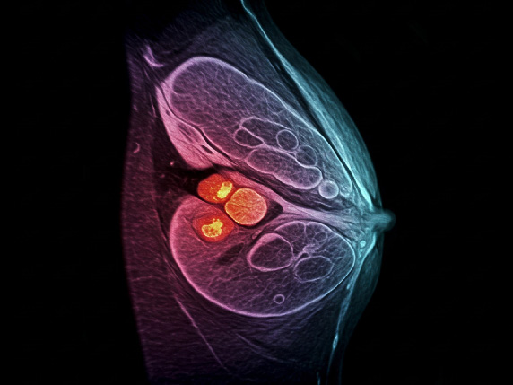 Side view image of breast cancer. (From AI)