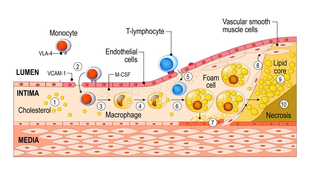 Fig.1 Atherosclerosis research illustration highlighting plaque inflammation, lipid accumulation, and vascular changes (Creative Biolabs Authorized)
