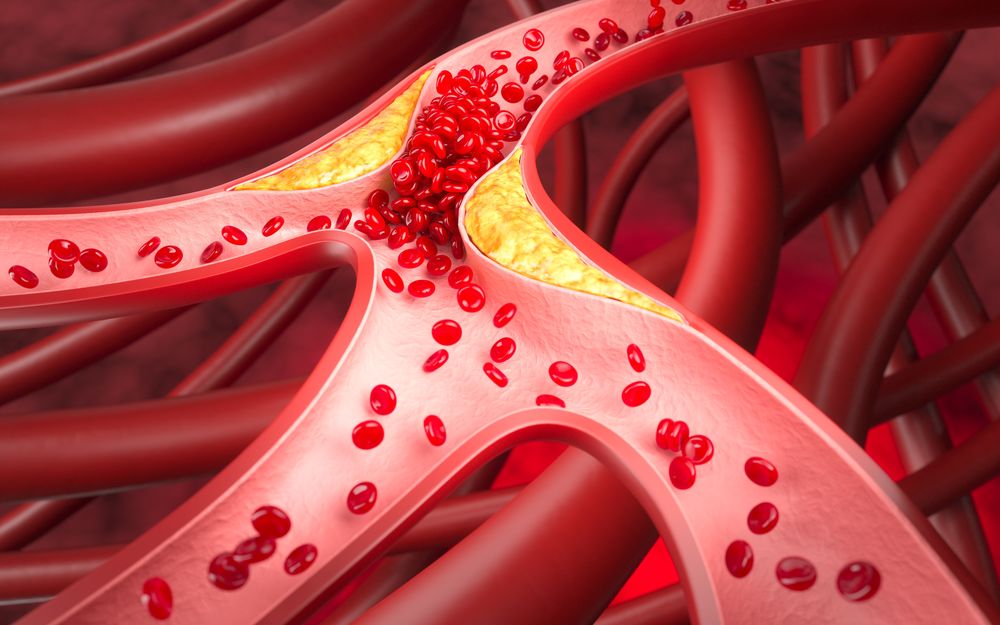 Atherosclerosis disease research illustration for antibody target exploration (Creative Biolabs Authorized)