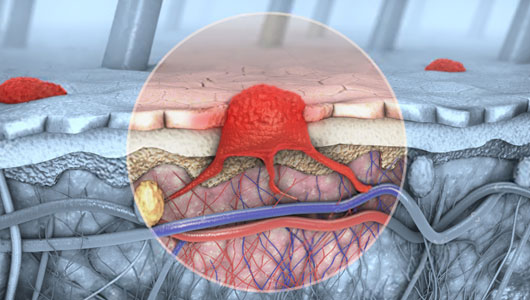 Basal-Cell Carcinoma (BCC) Overview - Signaling Pathway