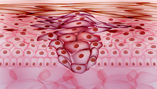 Melanoma Overview - Signaling Pathway