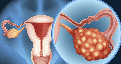 Ovarian Cancer Overview - Signaling Pathway