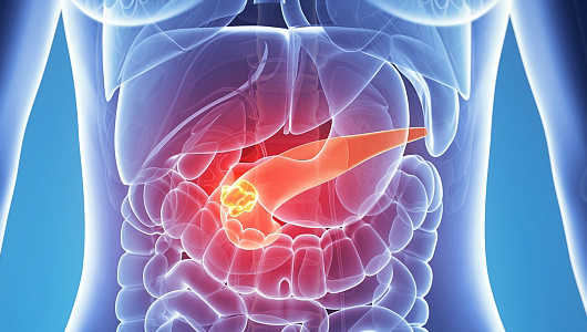 Pancreatic Cancer Overview - Signaling Pathway