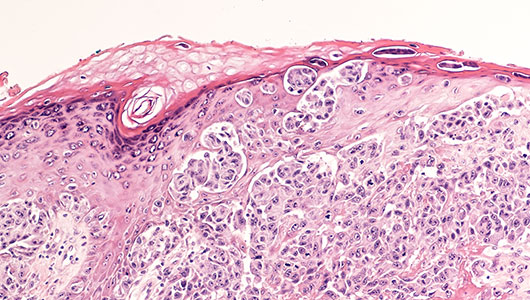 Skin Cancer (SCC) Overview - Signaling Pathway