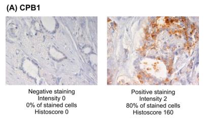 Fig. 1 Representative examples of CPB1 IHC in luminal A grade 1 tumors.