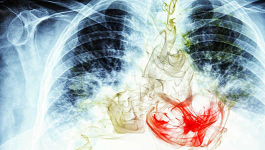 Lung Cancer Overview - Signaling Pathway