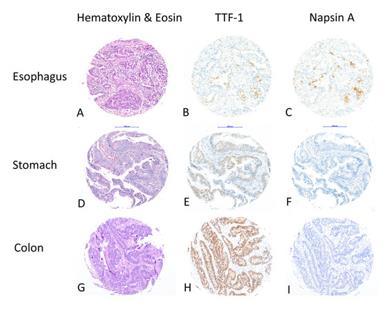 Fig. 1 Napsin A Expression in Gastrointestinal Adenocarcinomas. (OA Literature)