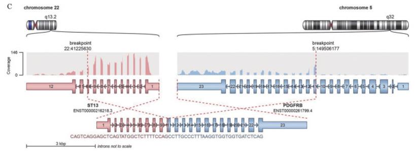 ST13-PDGFRβ fusion gene identified via whole transcriptome sequencing.