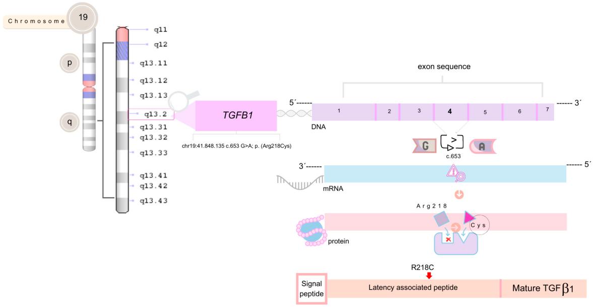 Arg218Cys mutation in TGFB1 LAP.